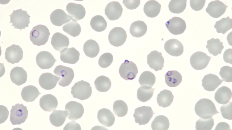 malaria