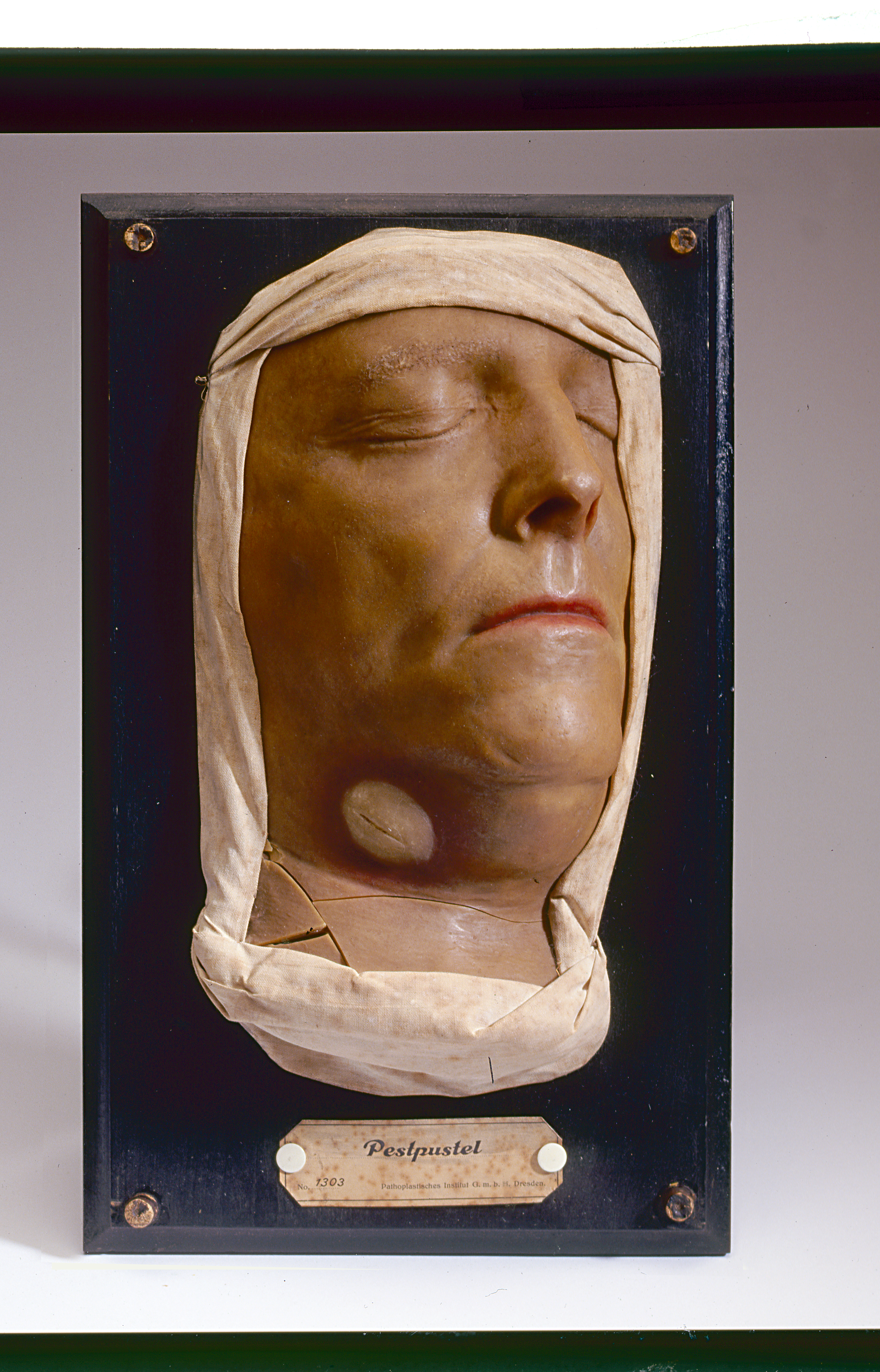 Wasmoulage met pestpustel uit ca 1900. Collectie Rijksmuseum Boerhaave